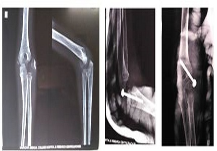 Late presenting lateral condyle fracture of the humerus in children - clinical outcome of surgical fixation