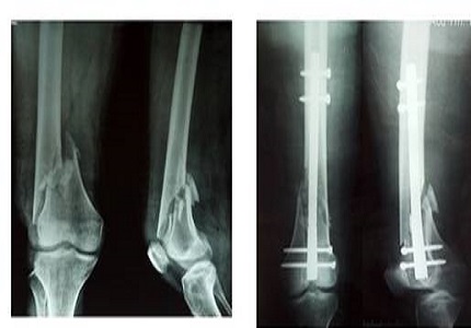 Comparison of outcomes of supracondylar femur fractures treated with locking compression plate vs supracondylar nail