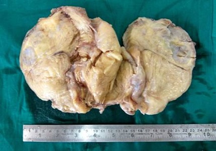 Cartilaginous metaplasia in giant fibrolipoma - arare case report