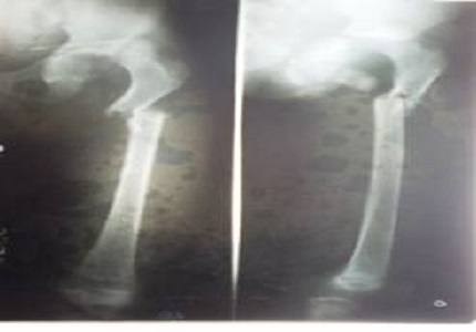 Posterior dislocation of hip with ipsilateral subtrochanteric fracture of femur in a child: a very rare case report