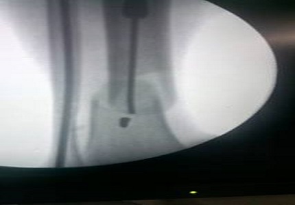 A Study to evaluate the use of Steinmann pin as Poller screw for diametaphyseal fracture of distal tibia to avoid angular deformity
