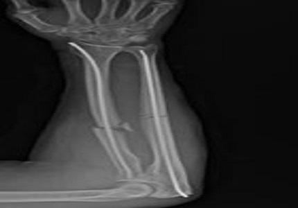 A comparative study between plating & intramedullary nailing for displaced diaphyseal fractures of radius and ulna in adults