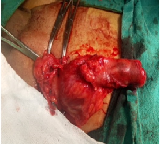 Incarcerated sigmoid colon with gangrenous appendices epiploicae:A rare case report