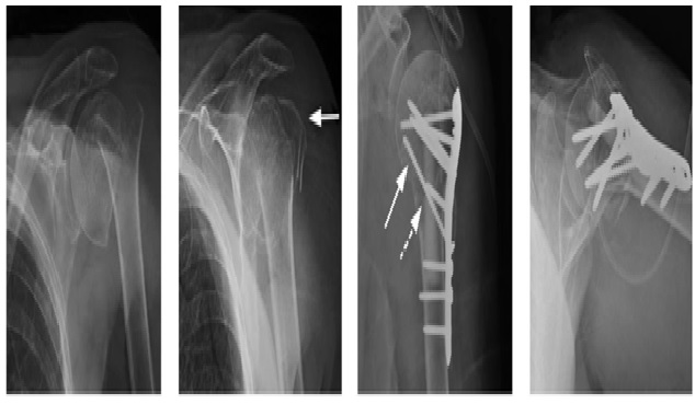 Locking compression plate for proximal humerus fracture: A functional outcome analysis