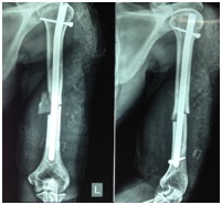 Comparative study of radiological and clinical outcomes by using single and double interlocking distal screws for humerusshaft fractures