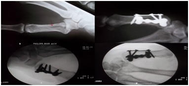 Orthogonal dual plating for fracture of base of 1st metacarpal- original study