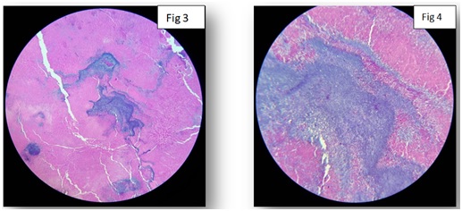 A case of primary actinomycosis and secondary eumycetoma in anterior abdomen wall – A case report