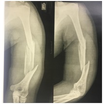 Study of radiological and clinical outcomes by using Anterior Bridge Plating (ABP) for humerus shaft fractures