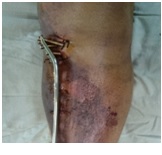 Supracutaneous plating in tibial metadiaphyseal fractures with compromised soft tissue using LCP as an external fixator